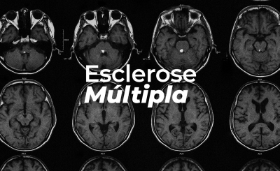 Esclerose múltipla: sintomas, diagnóstico, tratamento e tem cura?